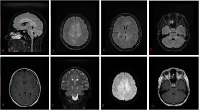 Case report: Relapsed/refractory extranodal natural killer/T-cell lymphoma nasal type with extensive central nervous system involvement